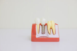 kansas city dental implants