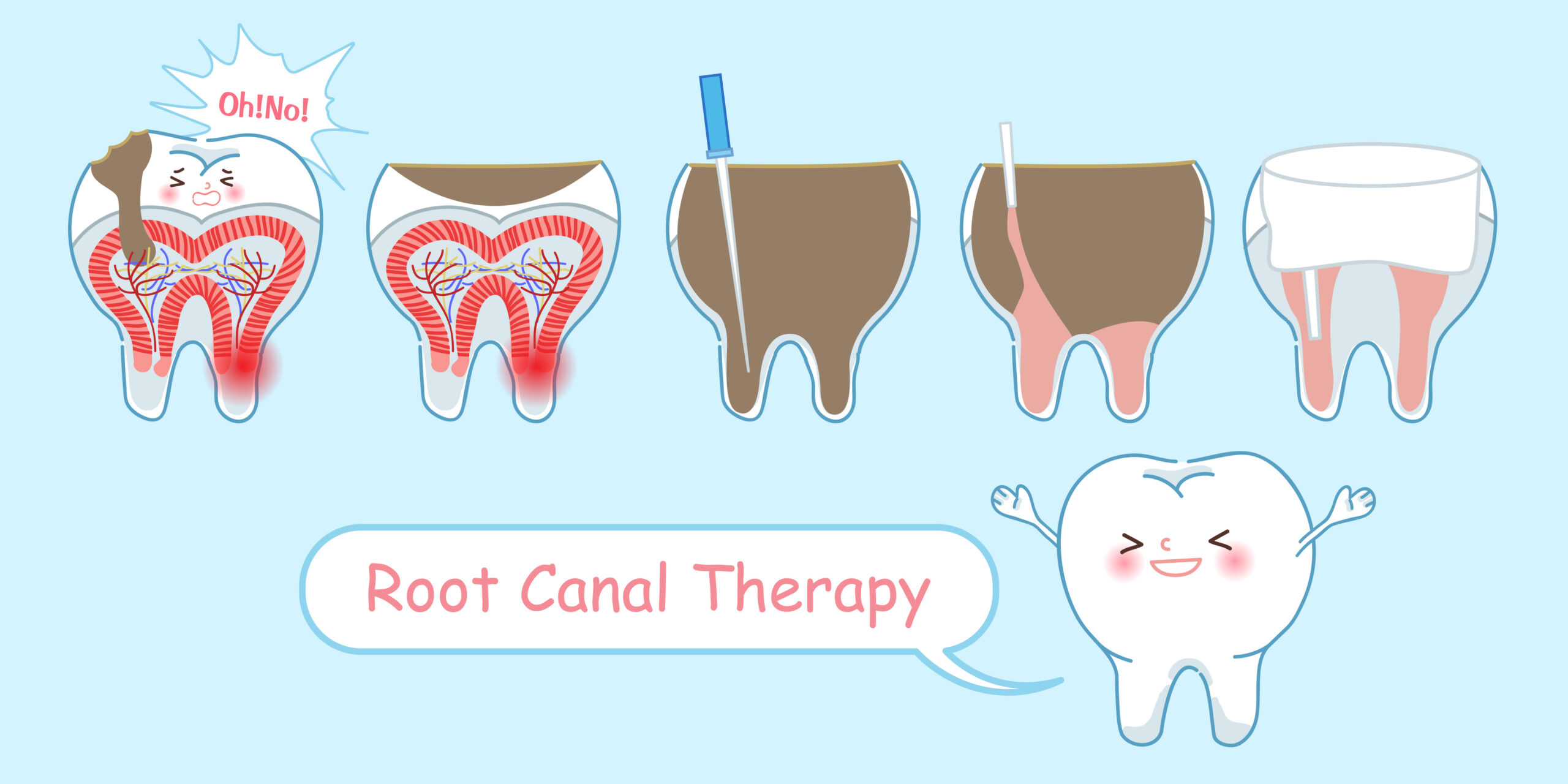 Kansas City, MO dentist offers root canals 